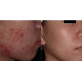 Лазерное лечение акне