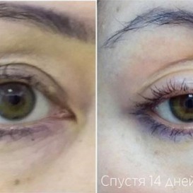 Фракционное омоложение