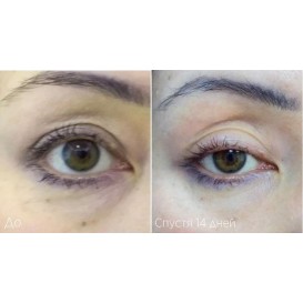 Фракционное омоложение