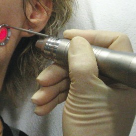 Лазерное лечение акне