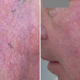 Лазерное удаление сосудов