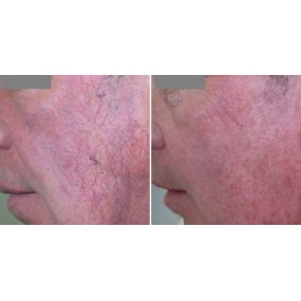 Лазерное удаление сосудов