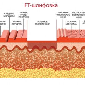 Лазерная шлифовка