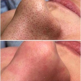 Чистка лица. Цены