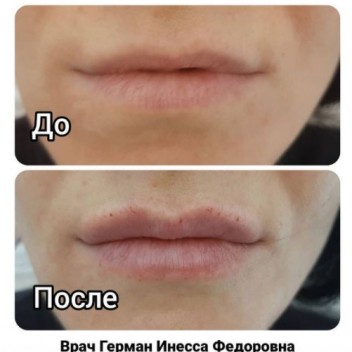 Увеличение губ в Иркутске