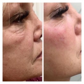 Контурная пластика