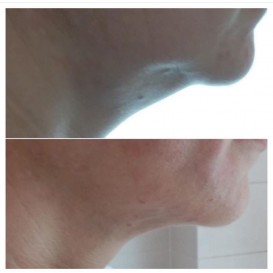 Подтяжка  лица нитями