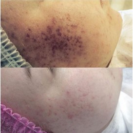 Химический пилинг