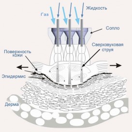 Газожидкостный пилинг JetPeel™