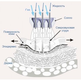 Газожидкостный пилинг JetPeel™
